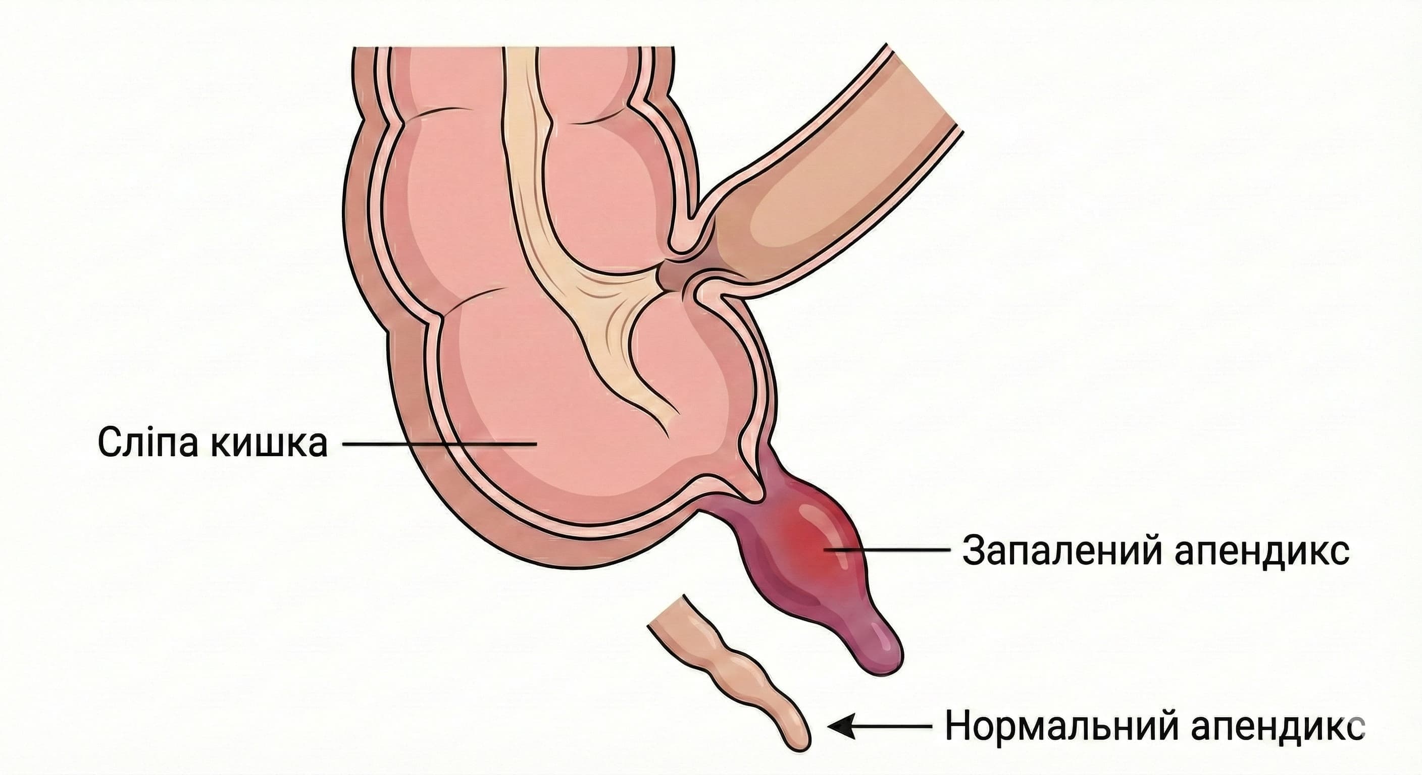 Ілеоцекальний кут, сліпа кишка, запалений апендикс