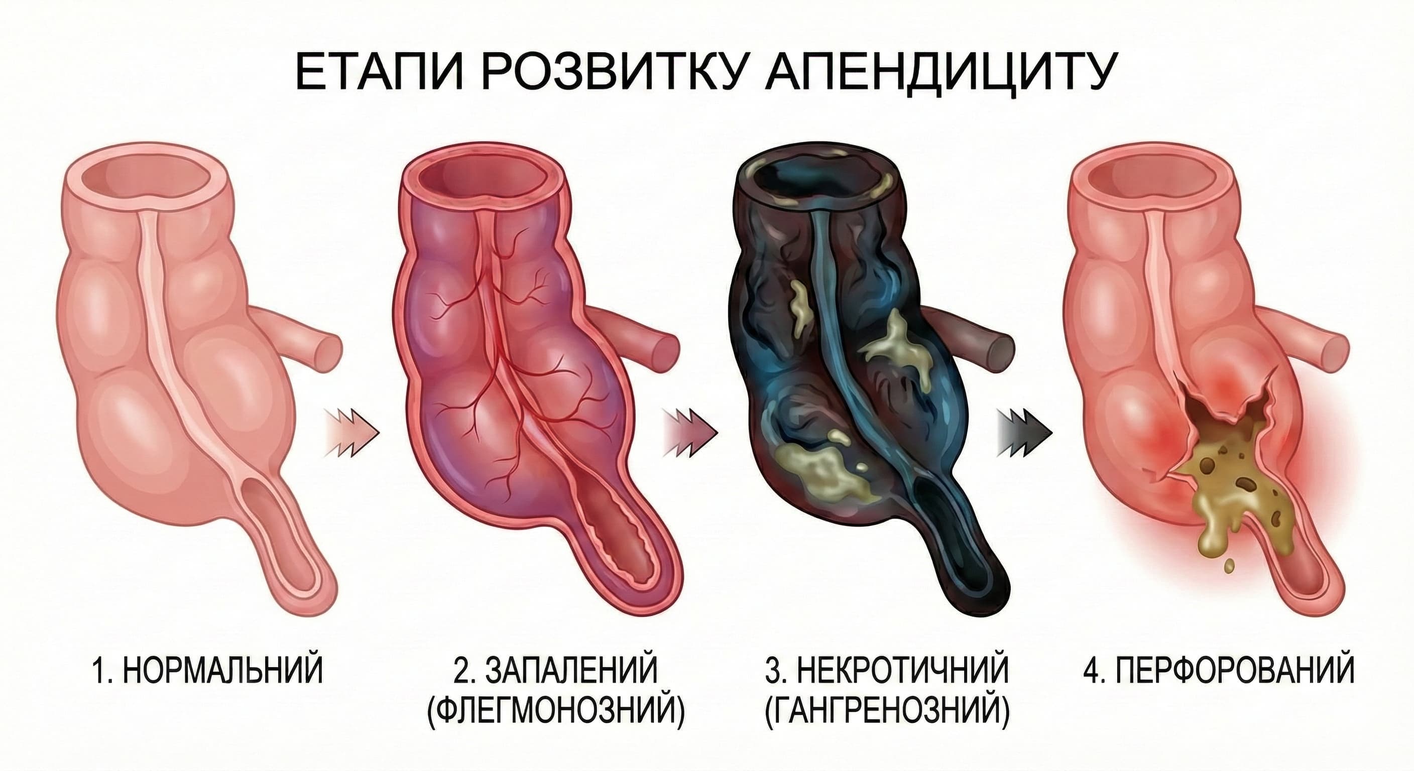 Схема розташування троакарів. Вигляд зверху на черевну стінку