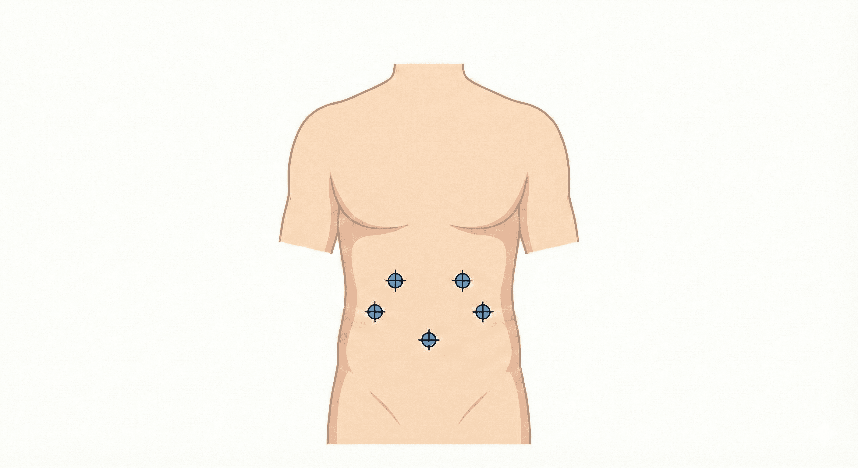 Схема розташування портів при лапароскопічній операції ГСОД